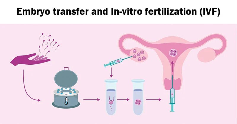 Embryo Vitrification