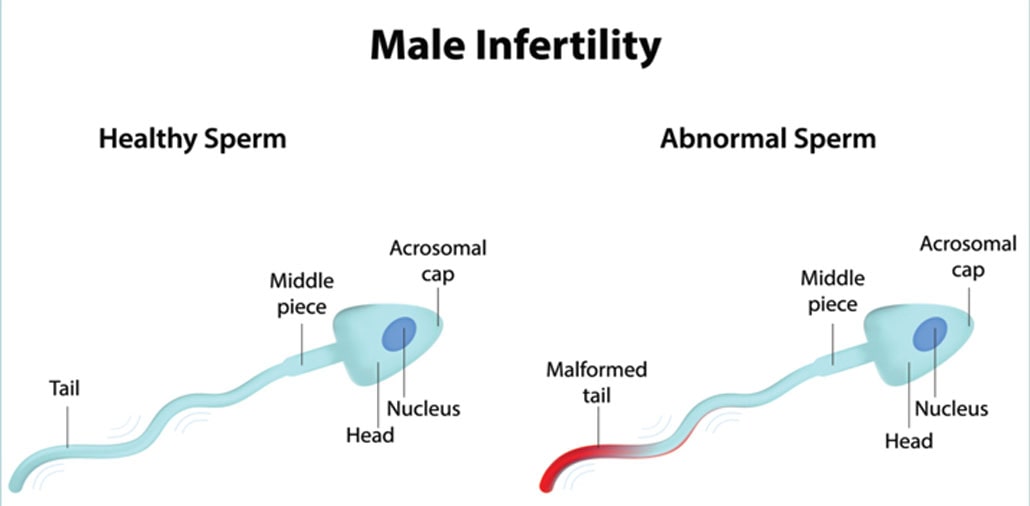 Men Infertility
