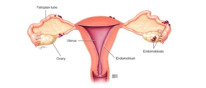 Endometriosis