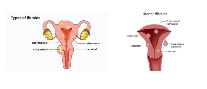 Fibroids