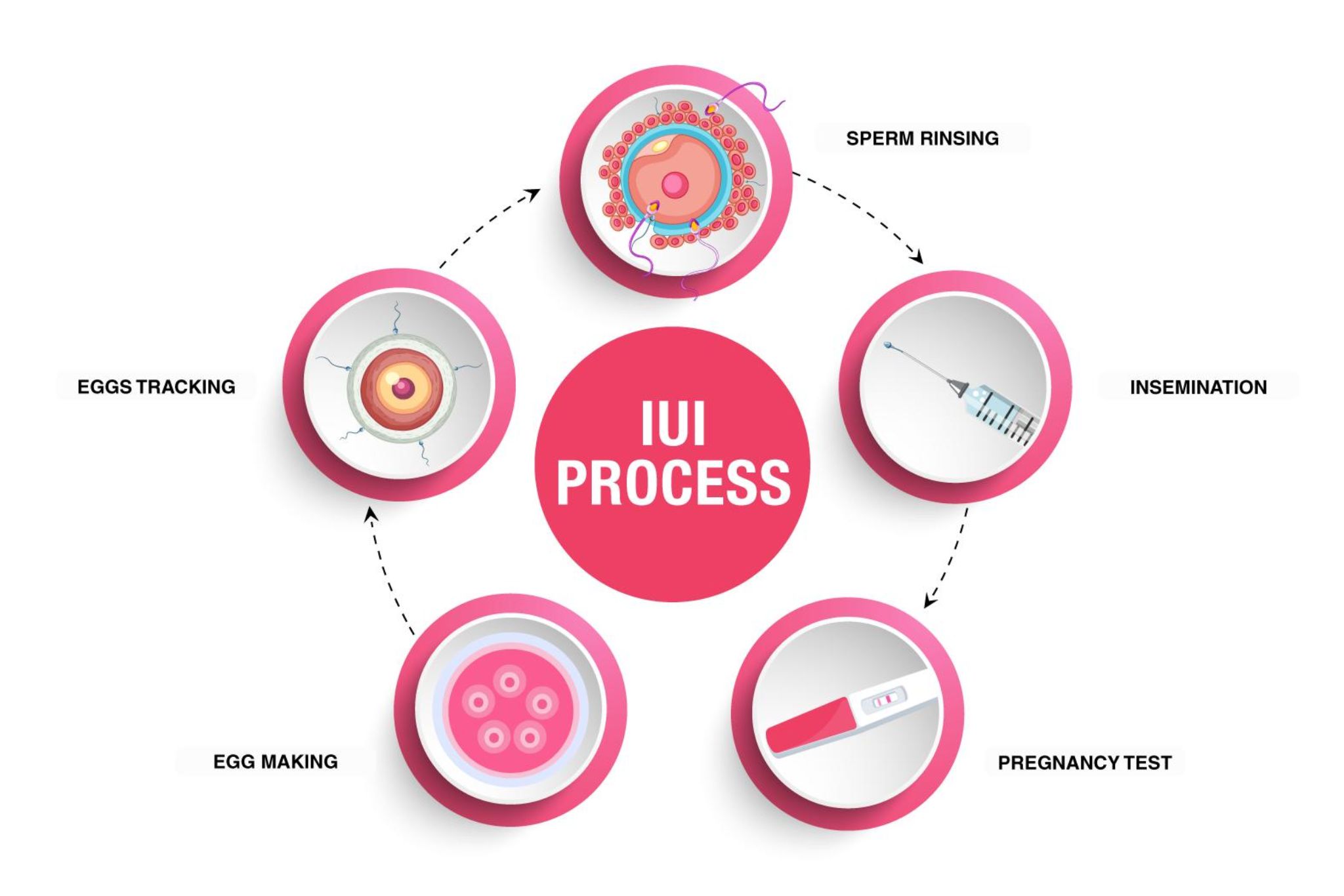 IUI Treatment