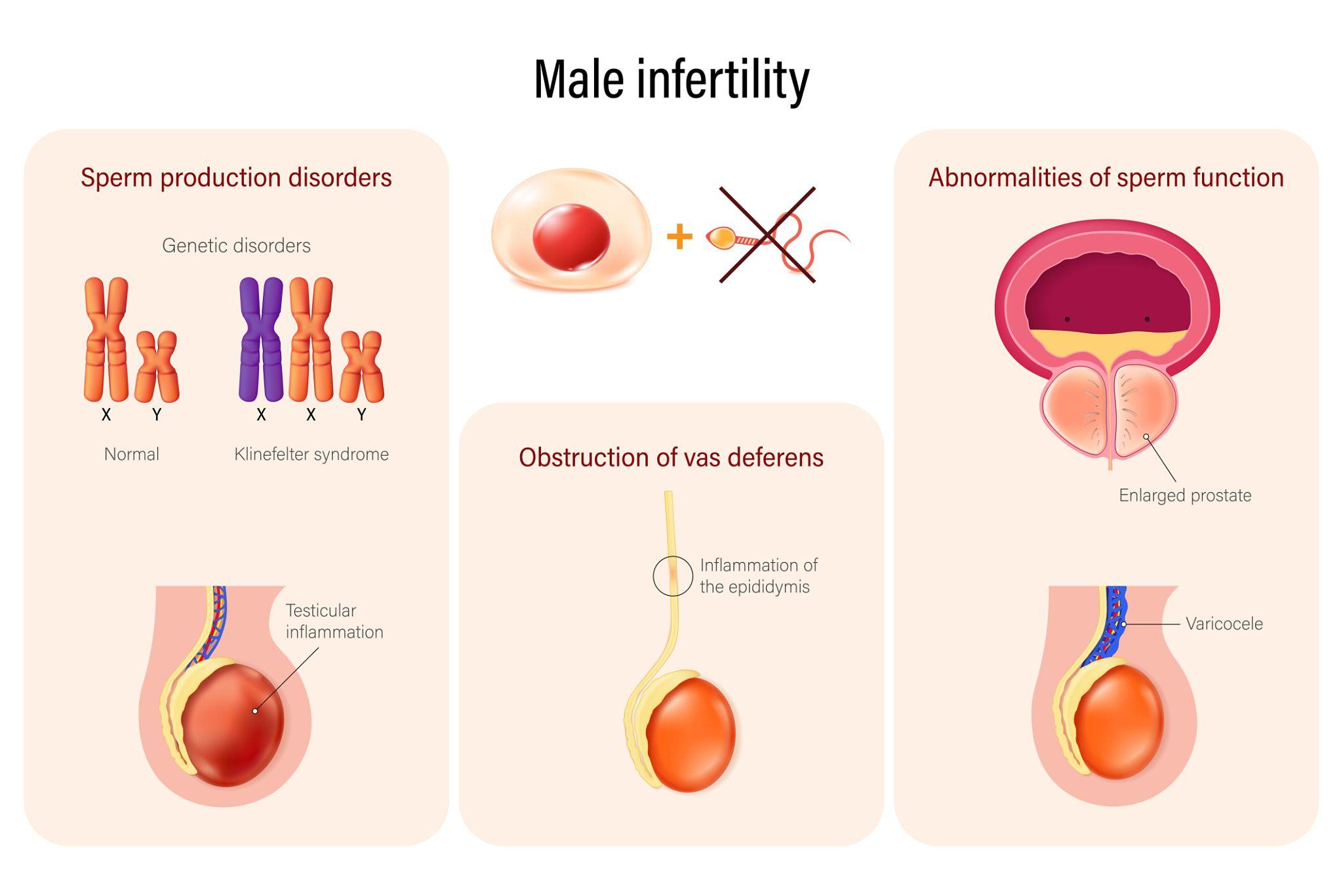 Men Infertility