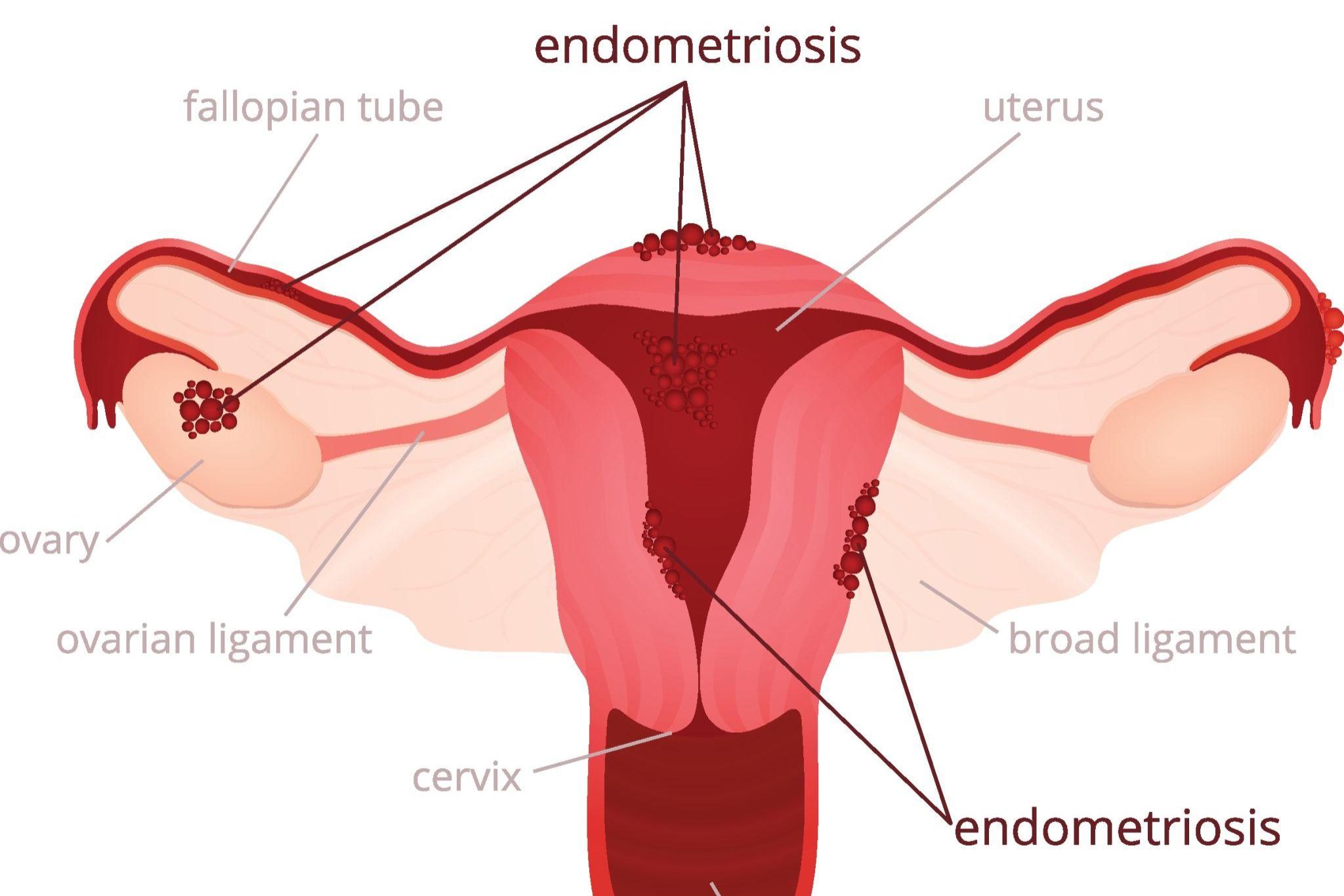 Endometriosis