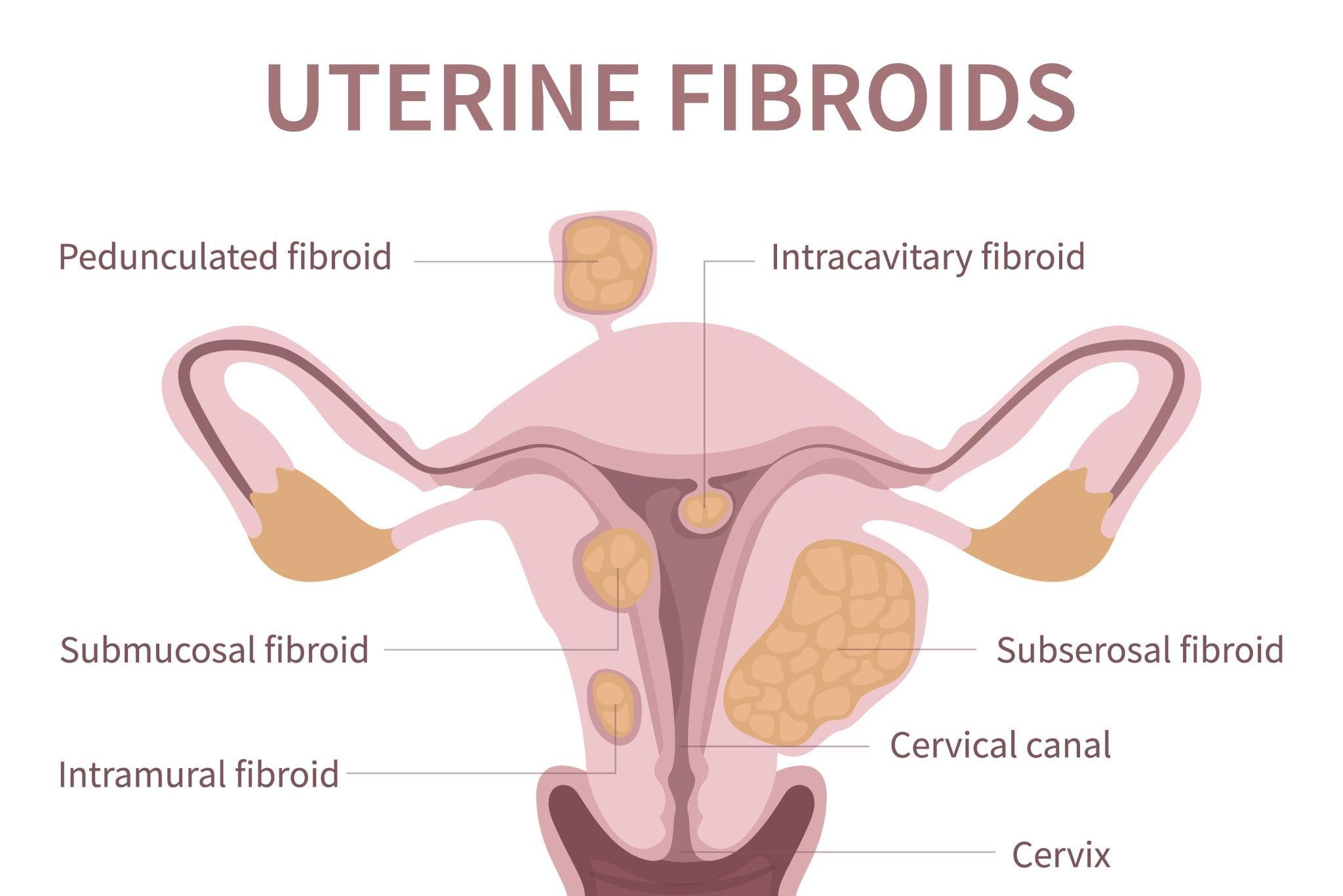 Fibroids Fibroids